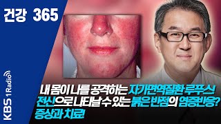 [건강365]내 몸이 나를 공격하는 자가면역질환 루푸스!  전신으로 나타날 수 있는 붉은 반점의 염증반응? 증상과 치료!  #루푸스#희귀난치성질환  #건강365  #자가면역질환