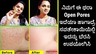 OPEN PORES - ಮುಖದ ಮೇಲೆ ರಂಧ್ರಗಳು \u0026 ಮೊಡವೆ ಇದೆಯಾ ಹಾಗಾದ್ರೆ ಇದನ್ನು ಉಪಯೋಗಿಸಿ !! Get Ride Of Open Pores !!