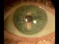 rotational nystagmus