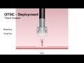 hcc 1472 lesson 11a2 hemostatic devices over the scope clips