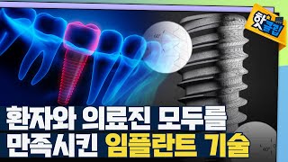 [핫클립] 특별한 기술력의 임플란트 / YTN 사이언스