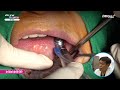 online surgery oneguide surgery with a oss graft on extraction site of 37