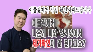 【CN SUB】이물질제거 흡입술하고 나온  물질이 피와 지방덩어리하고 엉켜있어서 확인이 안 된다고요? 그럼 더 이물질제거 확인하는 확실한 방법을 보여드리겠습니다.