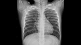 Python Simple Computer Vision Guided Project TensorFlow Pneumonia Prediction