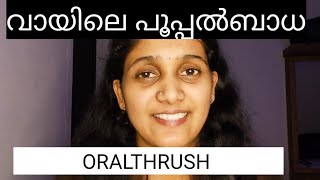 വായിലെ പൂപ്പൽബാധ/#Oralthrush #candidiasis #Dr chithra