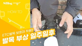 [HowTo] 발목 접질리고 일주일 됐습니 보호대 착용하고 보드타기