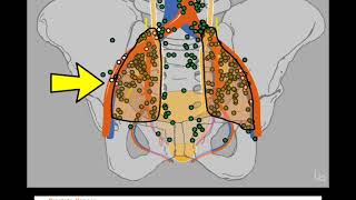 Extended pelvic lymph node dissection: The Monoblock Technique