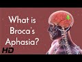 Broca's Aphasia and the Brain: What We Know and What We're Still Learning