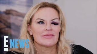 RHOSLC's Heather Gay Finally Comes Clean About Her Black Eye Mystery | E! News