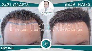 Hair transplant FUE - 2421 Follicles (6449 Hairs) - Dr. Rafael de Freitas | CLINICA DE FREITAS