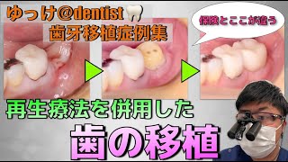 【歯牙移植症例集】再生療法を併用した自由診療における歯の移植🦷保険の移植とココが違う！保険の歯牙移植との違いやそれによるメリットについて解説します！！