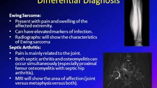 Osteomyelitis in children/ Bone infection in children