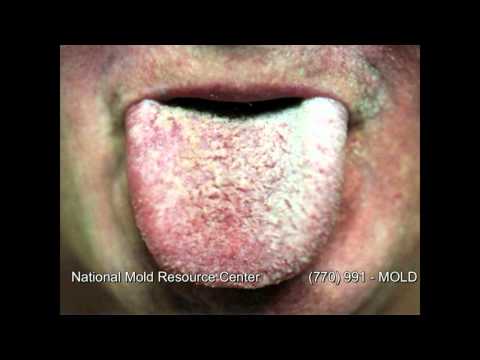 The Symptoms of Mold Exposure and Mold Illness from Black Toxic Mold Exposure The Symptoms of Mold Exposure and Mold Illness from Black Toxic Mold Exposure