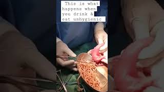 Taking out roundworms from patient's abdomen all due to unhygienic lifestyle  #hygienicfood
