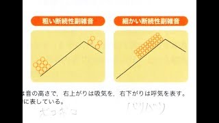 看護学生講座 147 聴診 ｢呼吸音の異常 どんな時にどんな音？｣