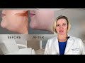 kybella® noninvasive fat destruction