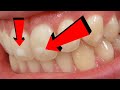 What Causes White Spots on Teeth  | How To Cure it - Home Remedies