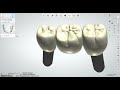 3shape design implant bridge 18 20