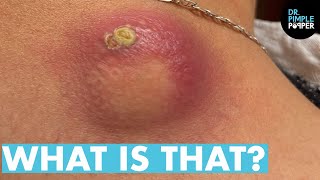 WHAT IS THAT! Dr Lee Pops Satisfying Back Cyst | Dr Pimple Popper Reacts