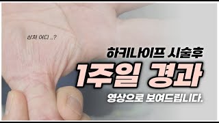 [털보의사] 방아쇠수지 5단계 아주 심한 환자의 하키나이프 시술 1주일 경과 영상으로 보여드립니다.