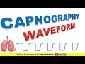 Capnography waveforms | Normal capnography waveform | Abnormal capnography waveform