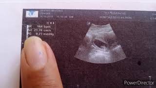 FHRदिल की धडकन से जाने लड़का है या लड़की।अल्ट्रासाउंड में कहाँ लिखा होता है 8 weeks 5DAYS ultrasound