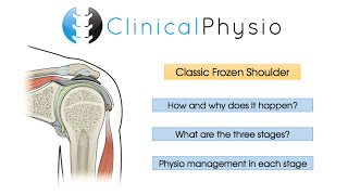 Classic Frozen Shoulder | Clinical Physio