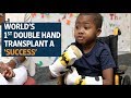 World’s 1st double hand transplant a success