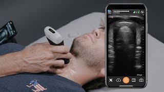 POCUS to Confirm Endotracheal Tube Placement