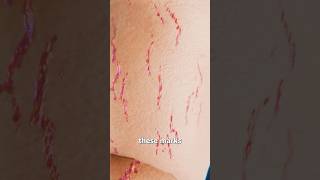 How Stretch Marks Appear 😮 Surgeon Reacts
