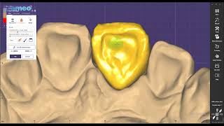 Aidite Exocad design guide: Anterior teeth design