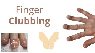 Finger Clubbing - Introduction, Pathophysiology \u0026 Causes - Mnemonic to remember causes of CLUBBING❤️