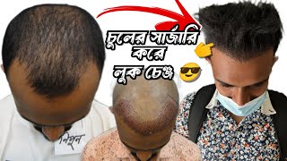 চুল লাগানোর পর লুক পুরাই চেঞ্জ 😎 মাএ ১৩০০ গ্রাফট হেয়ার লাইন | Hair Transplant Bangladesh