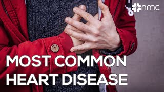 Most Common Heart Disease - NMC Doctor Video