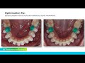 Engaging with Self-Ligation Achieving your goals with low force and light wires