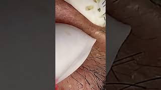 Skincare | Blackheads Removal #385 #tweezers skincare #blackheads blackheads