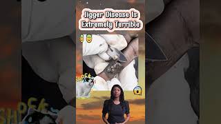 Jiggers removal now Parts 64 😱😱O m g   Satisfying lets dig jiggers out#64#satisfying #asmr #jigger