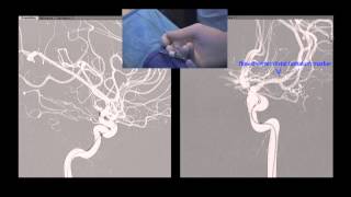 [TEASER] Endovascular treatment of intracranial aneurysm with flow diverter (www.mposium.com)