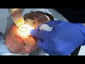 GETTING LASER TO FIX MY RED COMPLEXION WITH DR. JASON EMER | RED CHEEKS DUE TO ACNE