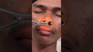 nose cancerAllImagesShort videosVideosNewsWebBooksMapsFinanceSearch toolsFeedbackNasal and sinus