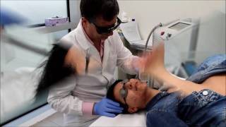 Trattamento dell'acne attiva con il laser BBL