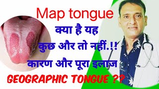 जीभ पर धब्बे,दरारें,सफेदी क्या है ? कैंसर ?? geographic tongue tongue, causes treatment। map tongue