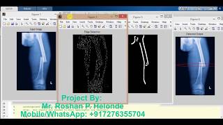 Matlab Code for Bone Fracture Detection using Image Processing