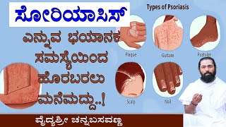 ಸೋರಿಯಾಸಿಸ್  ಸಮಸ್ಯೆ ಹೊರಬರಲು ಮನೆಮದ್ದು | Home remedies to get rid of psoriasis | Turmeric | Alalekayi