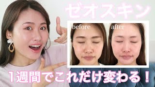 【ゼオスキン】1週間の経過【衝撃】シミ薄くなりました。