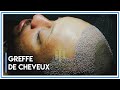 Activités Que Nos Patients Peuvent Faire Après Une Greffe de Cheveux