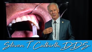 Diagnosing and Treatment of a Cracked Tooth - Dental Minute with Steven T. Cutbirth, DDS