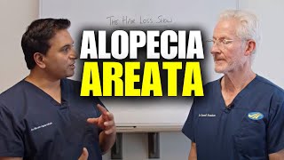 Alopecia Areata: An In-Depth Discussion