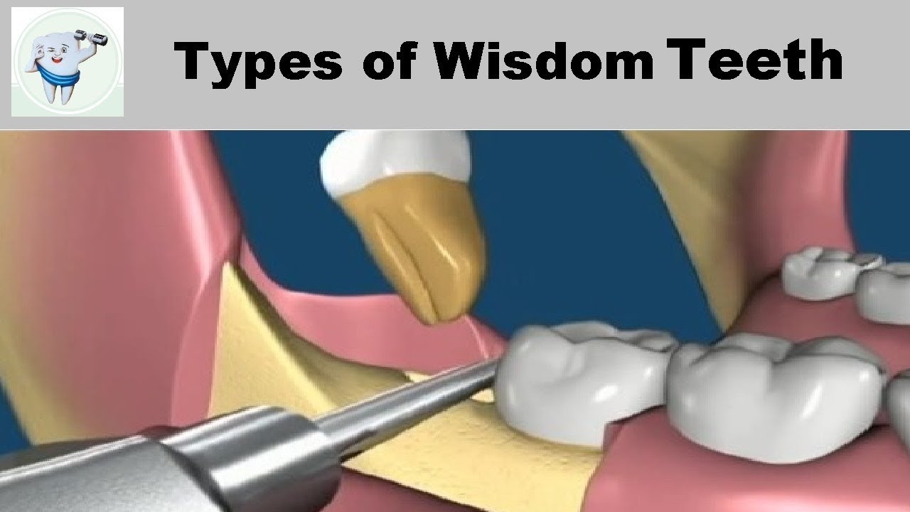 Types Of Wisdom Teeth Removal - YouTube