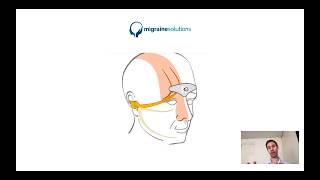 Independent review of the Cefaly migraine prevention device by Dr Cameron Kealy